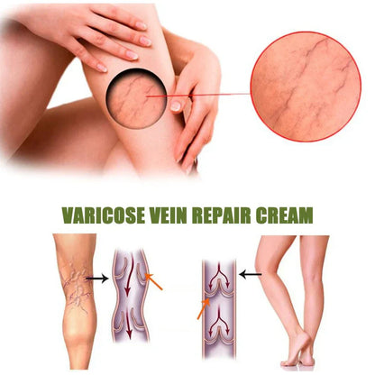 MEDix™ Varicose Veins Spray