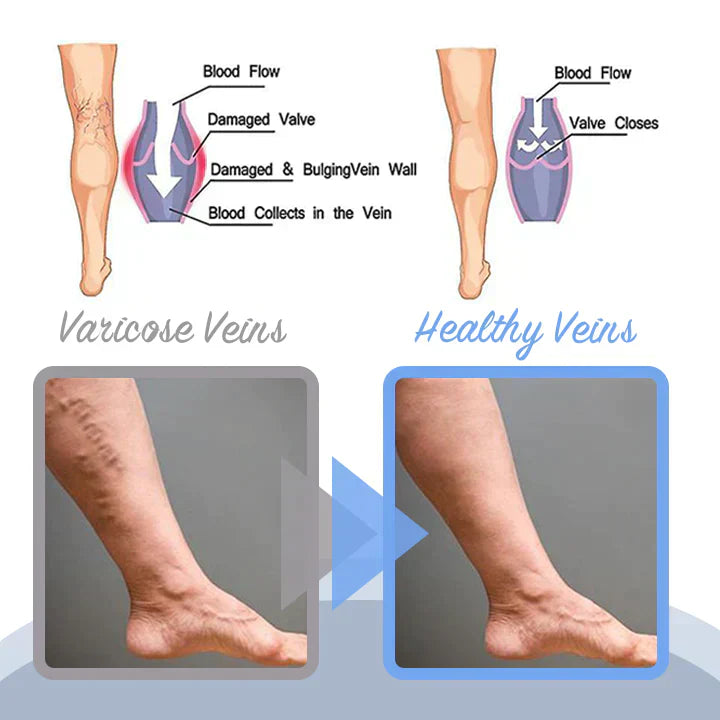 MEDix™ Varicose Veins Spray