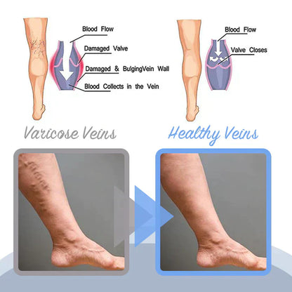 MEDix™ Varicose Veins Spray